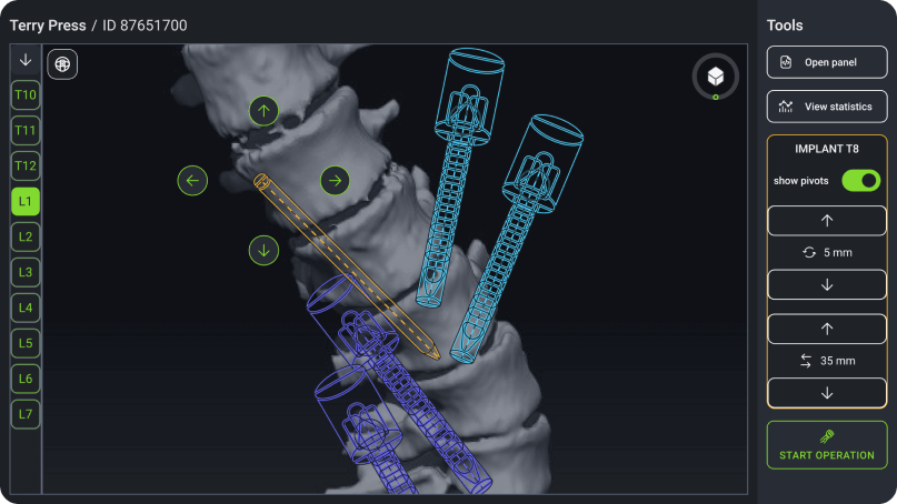 Custom medical software for spine surgery system
